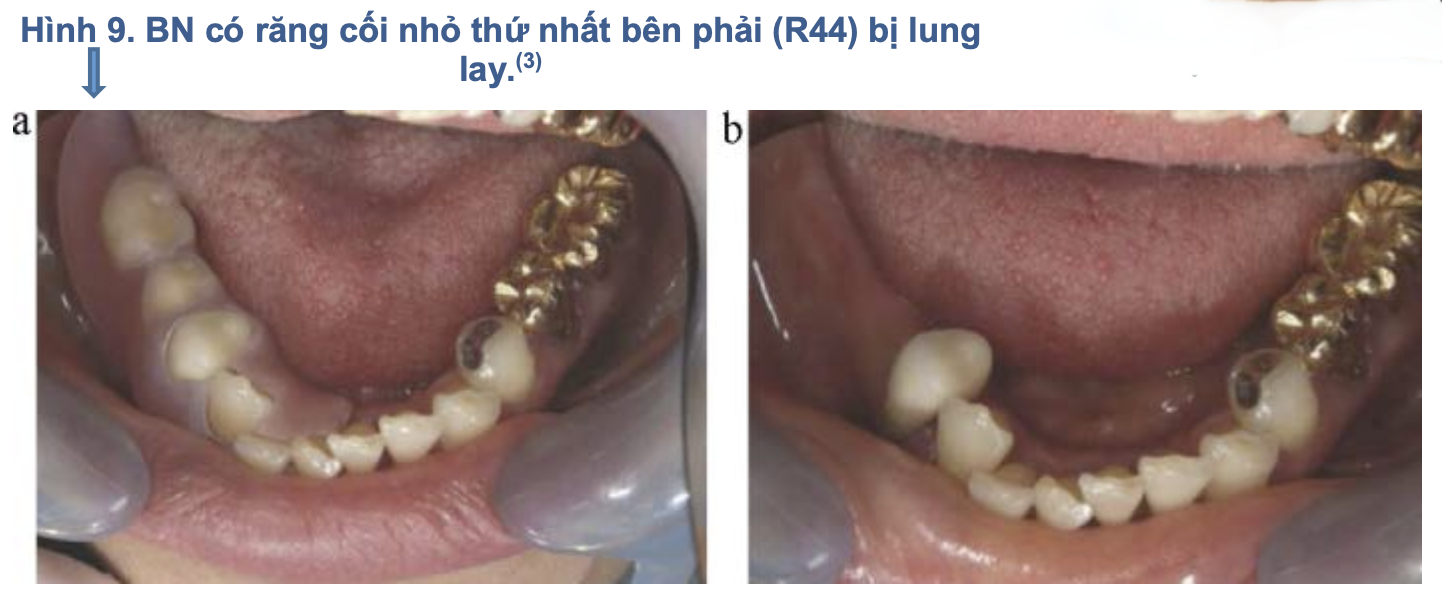 Hàm nhựa dẻo trong phục hình tháo lắp: Đặc tính, chỉ định và biến chứng lâm sàng